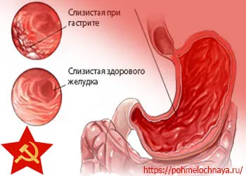 Рвота после алкоголя - Лечение алкоголизма